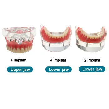 Dentista Enseñanza de Dientes Modelo Dental de los Dientes con el Modelo de Implante Removeble Puente de la Dentadura Modelo de Demostración
